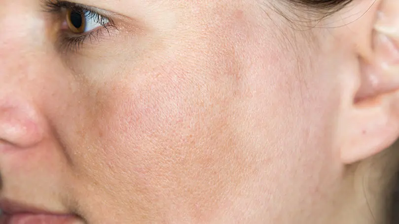 Nahaufnahme auf Wange einer Frau mit Pigmentflecken