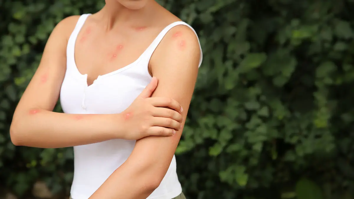 Frau mit mehreren roten Stichen an den Armen und am Dekolleté
