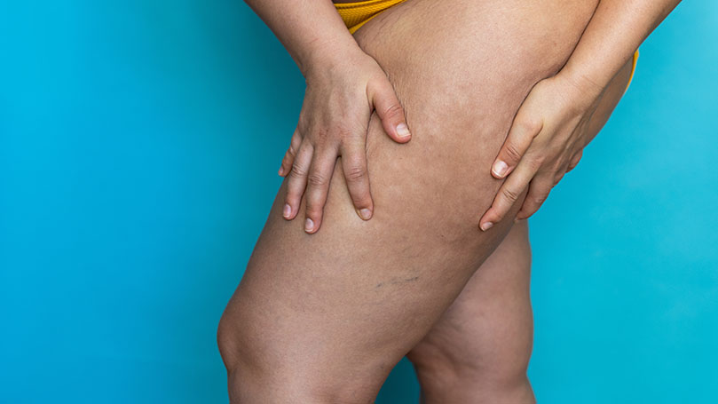 What exactly is lipedema?