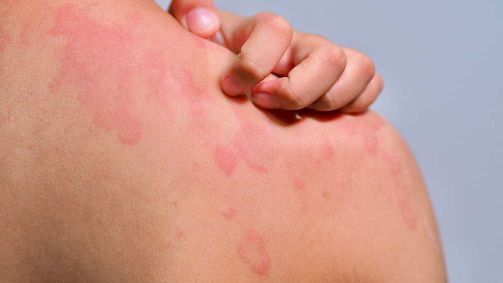 Hautausschlag, rote runde Flecken auf der Schulter