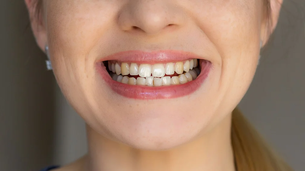 Frau zeigt Zähne, teils sind die Zähne gelblich verfärbt