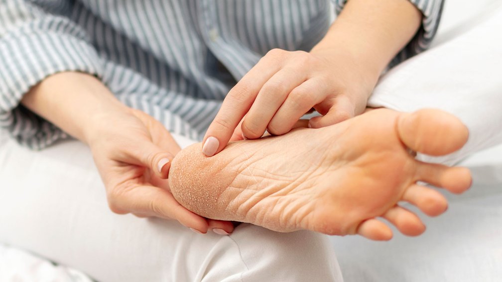 Frau legt Fuß auf Oberschenkel; am Ballen ist Hornhaut zu sehen