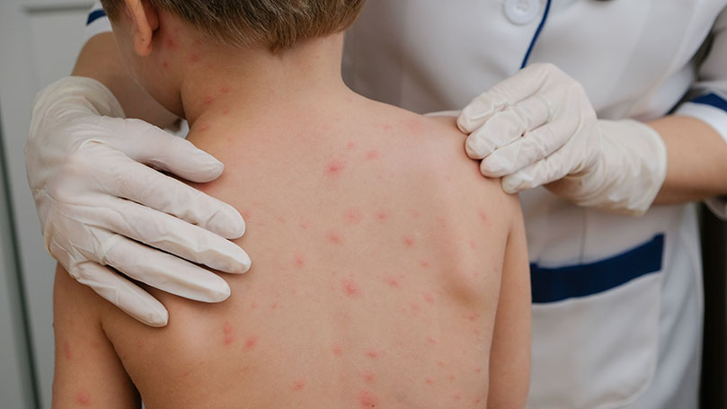 Varicella Vaccination: The Most Important Information on Immunization ...