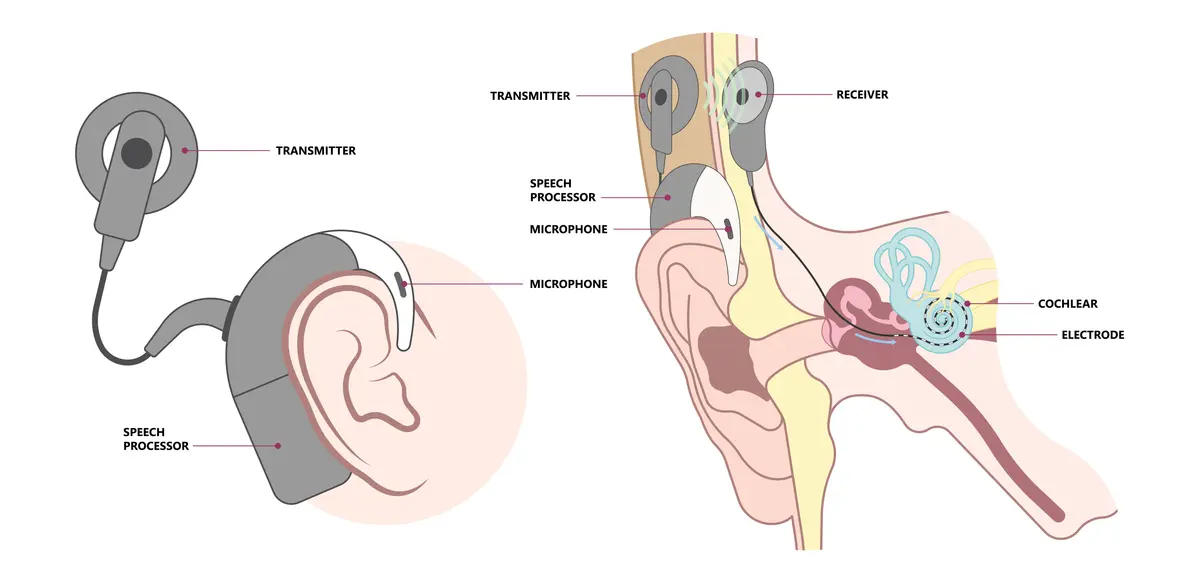 Grafische Darstellung zur Funktionsweise eines Cochlea-Implantats