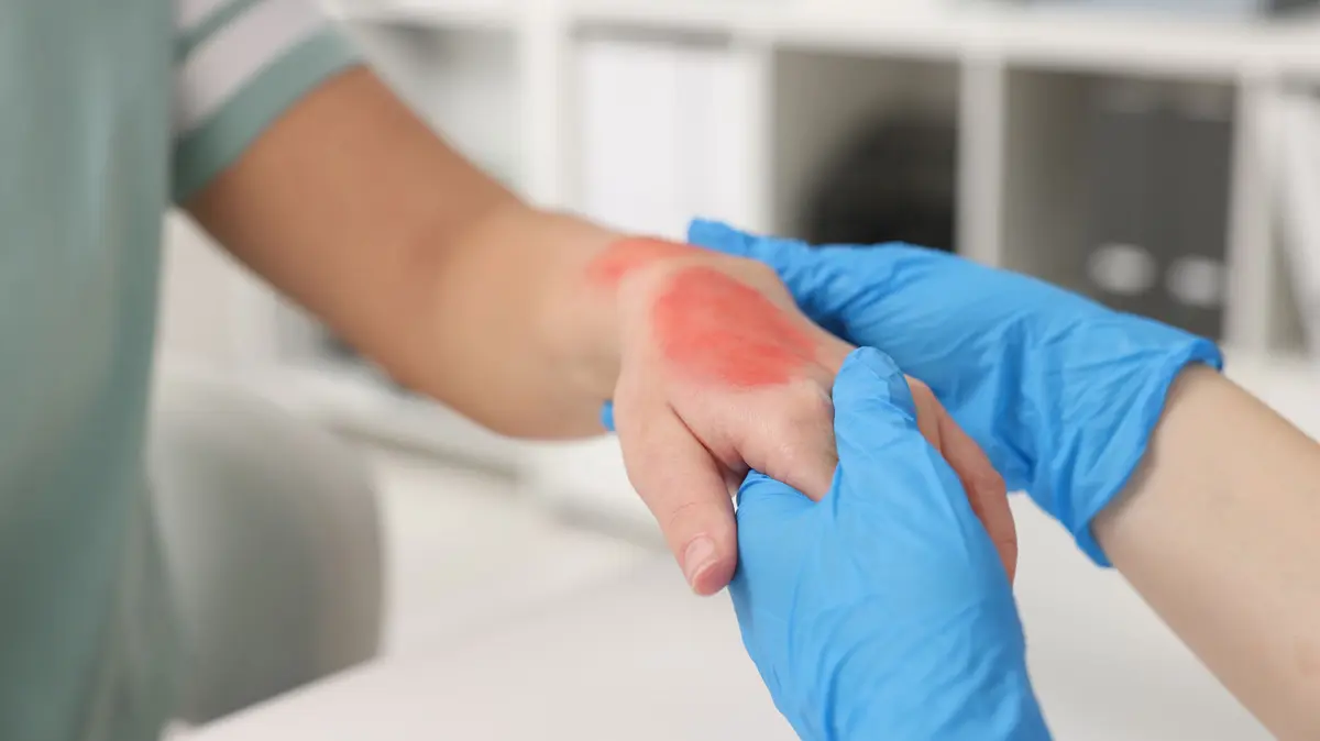 Person mit Verbrennung auf der Handaußenseite; Arzt schaut sich die Hand mit Einmalhandschuhen an