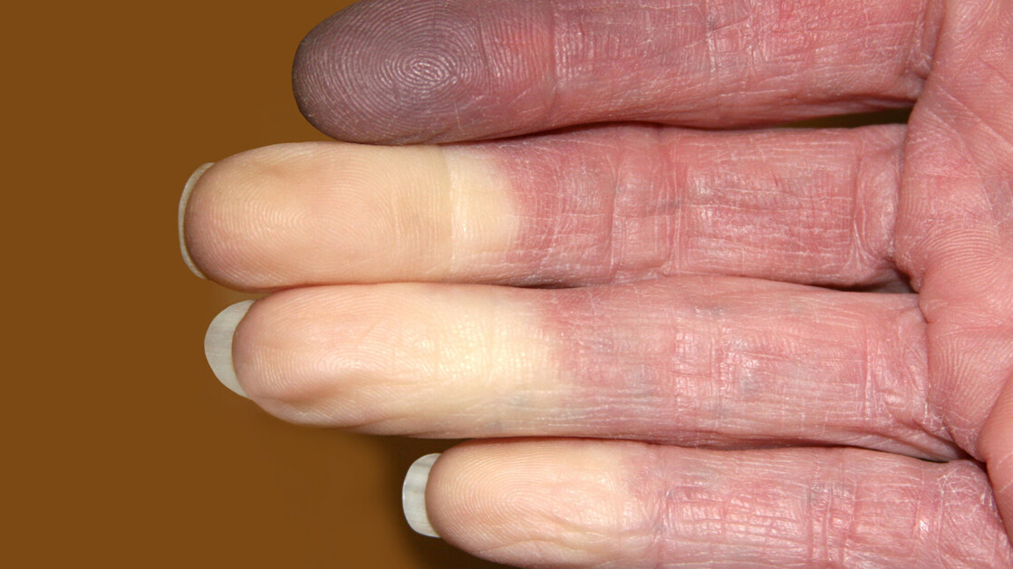 Was ist eigentlich das Raynaud-Syndrom? - PTAheute