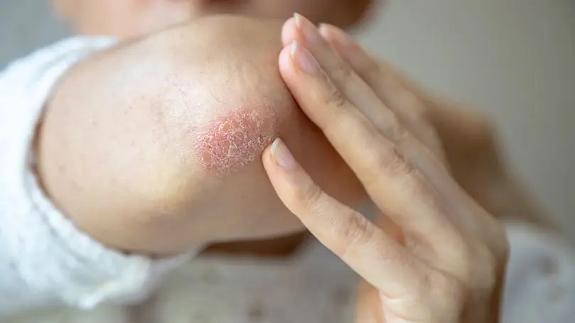 Frau hält Ellenbogen mit Schuppenflechte in die Kamera