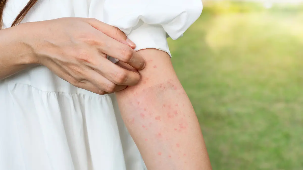 Frau juckt sich am Arm, rote Stiche sind sichtbar