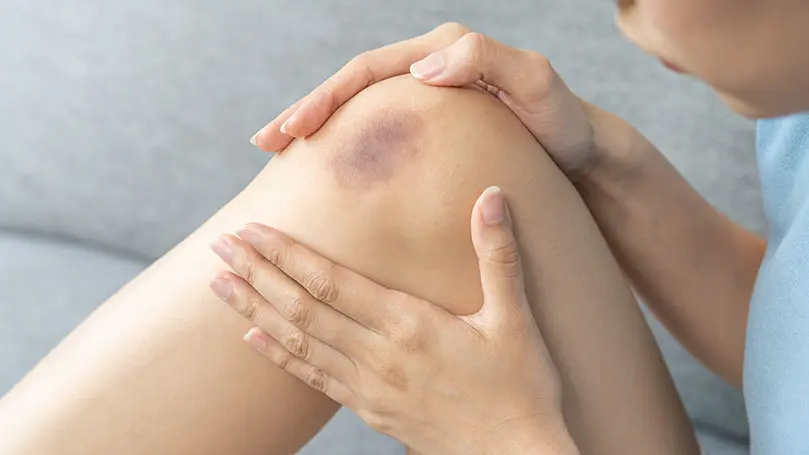 Frau mit Bluterguss am Knie