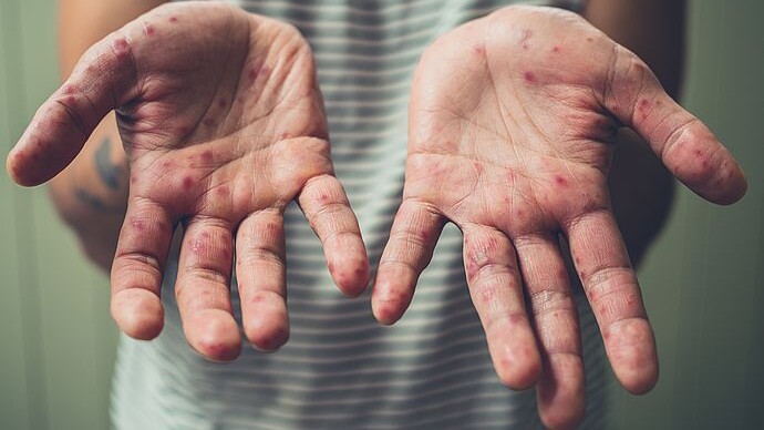 Hand Mund Fuß Für Erwachsene Ansteckend www.ptaheute.de