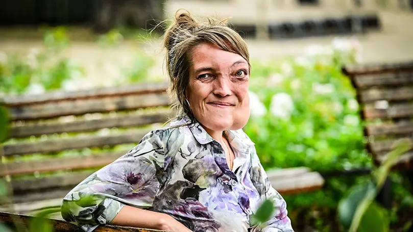 junge Frau mit Verformungen im Gesicht