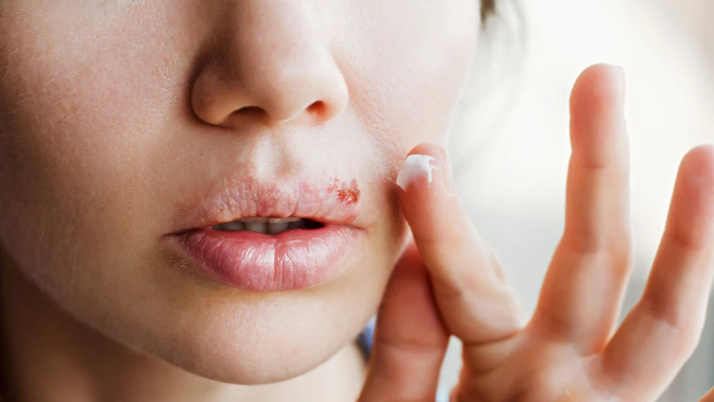 Frau mit Herpes-Bläschen an der Oberlippe