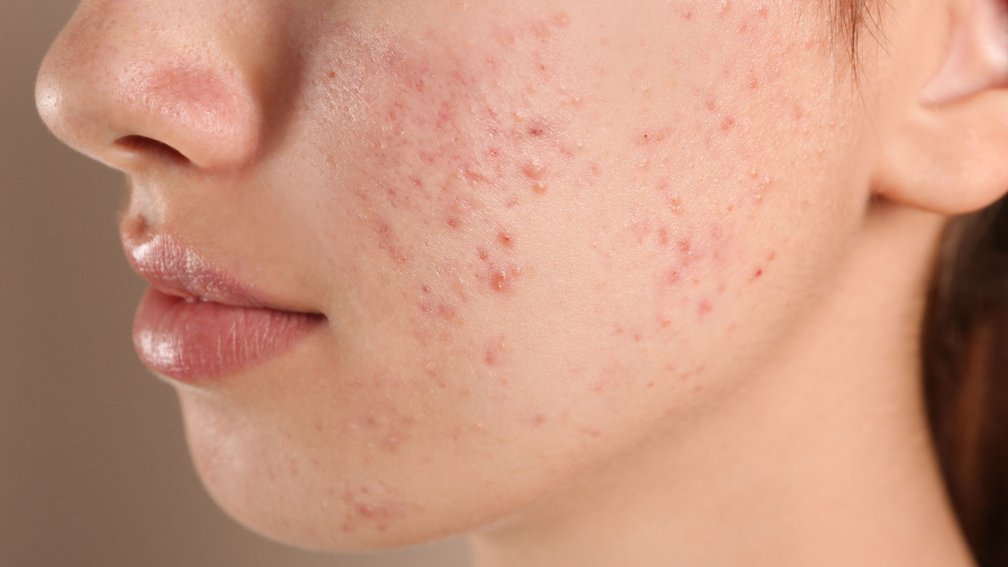 Teenager im seitlichen Profil, mit Akne auf der Gesichtshaut