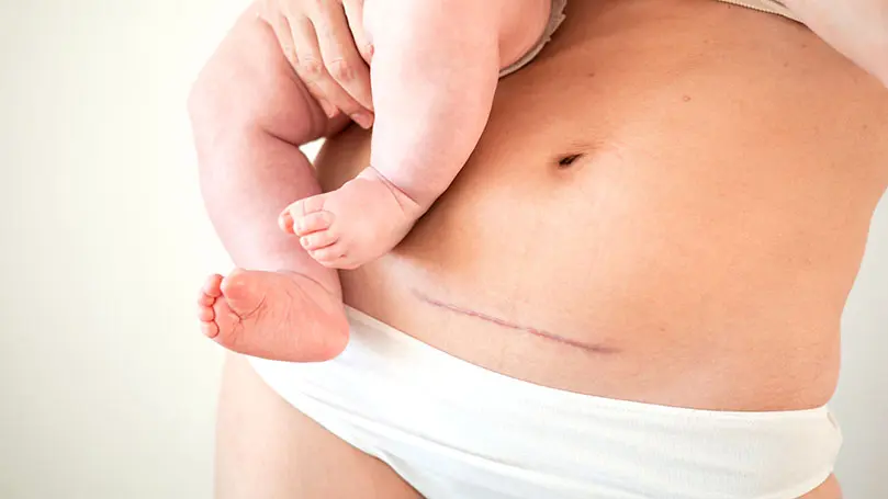 Frau mit Kaiserschnittnarbe trägt Baby auf der Hüfte
