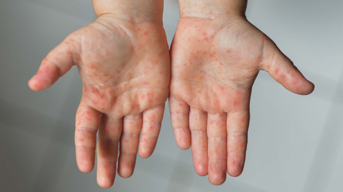 Wie Lange Ist Hand Fuß Mund Ansteckend Was ist eigentlich die Hand-Fuß-Mund-Krankheit? - PTAheute