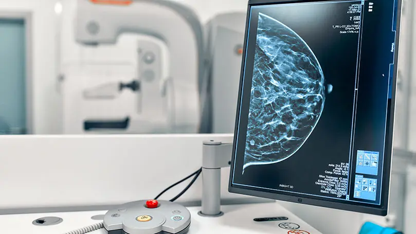 Computerbildschirm zeigt eine Mammografie-Aufnahme