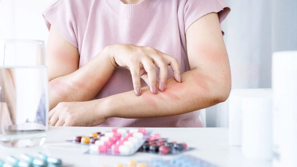 Frau kratzt sich am Unterarm, vor ihr liegen Blister mit Tabletten und Kapseln